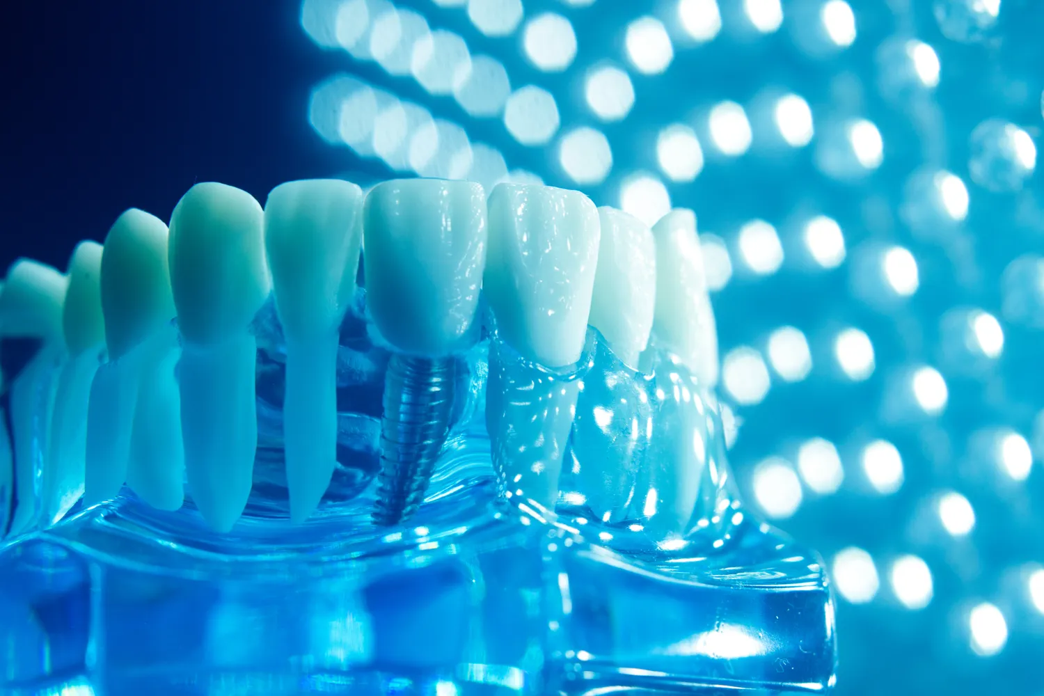 Implanty zębów Łódź gdzie najlepiej?